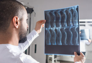 Pembroke Pines spinal cord injury lawsuit